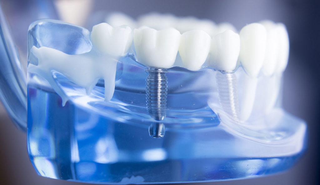 dental implants north raleigh